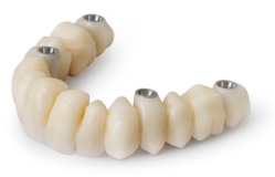 Screw Retained Bridge