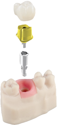 Split file with zirconia crown, titanium custom abutment, DIM analog, and soft tissue model