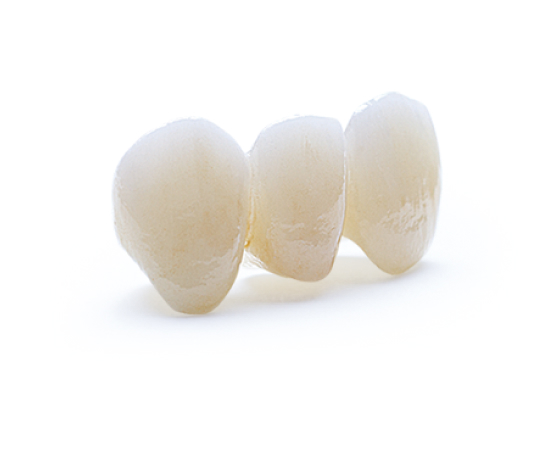 ArgenZ Zirconia Anterior milled bridge