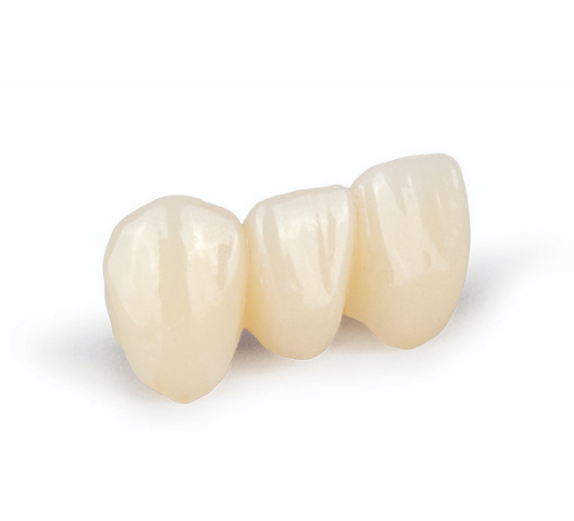 ArgenZ ST Multilayer Zirconia milled 3-unit bridge